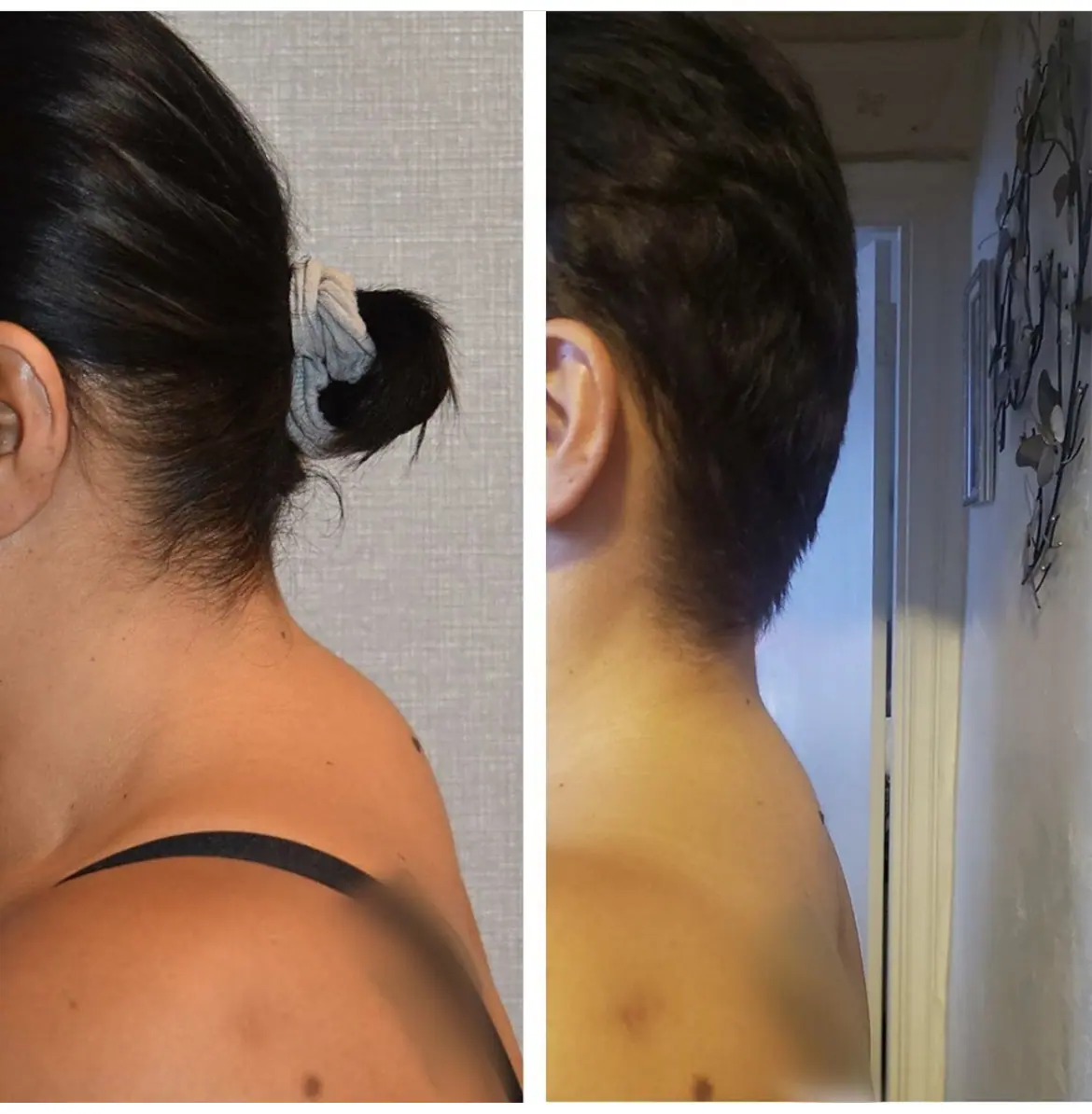 Before and after liposuction, case 31.