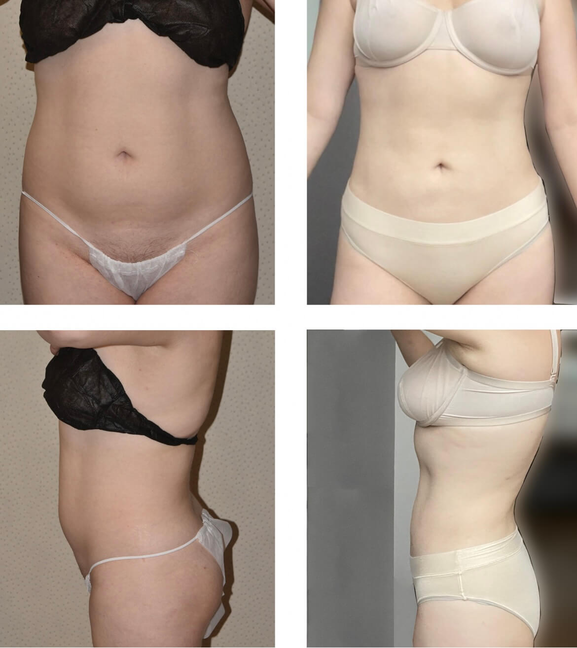 Before and after liposuction, case 32.