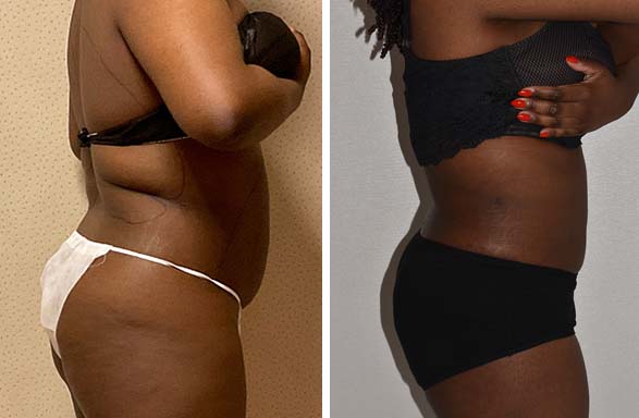 Before and after liposuction, case 33.