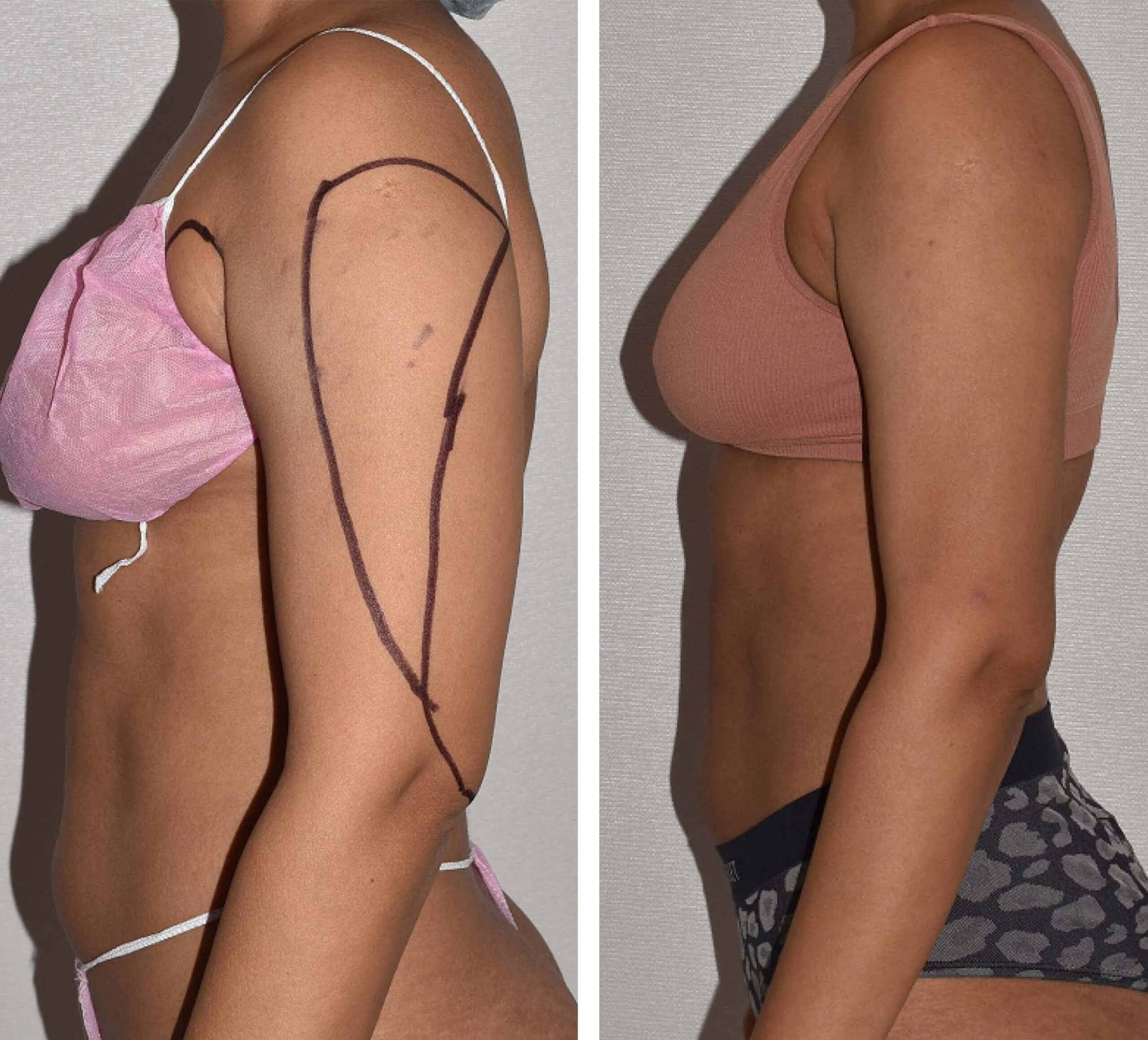 Before and after liposuction, case 34.