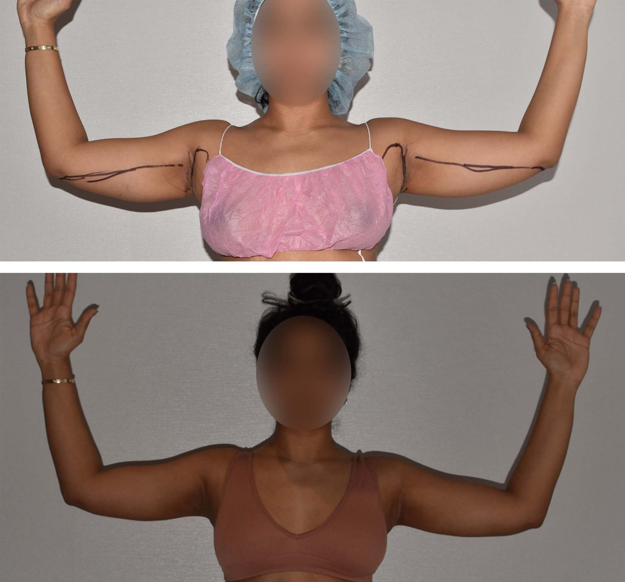 Before and after liposuction, case 35.