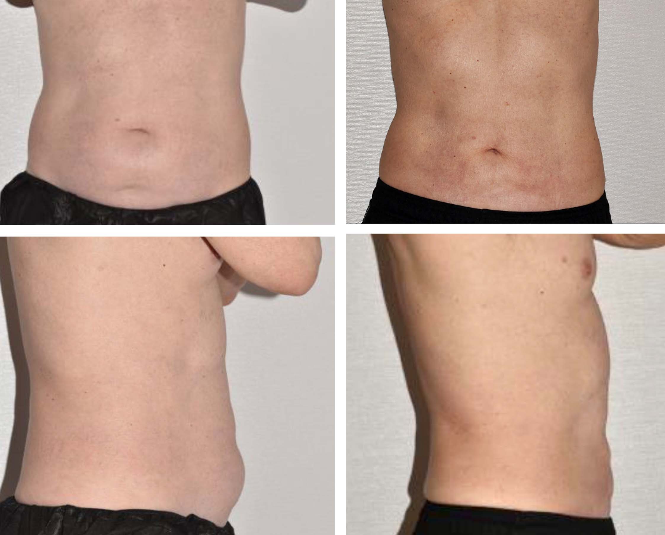 Before and after liposuction, case 36.