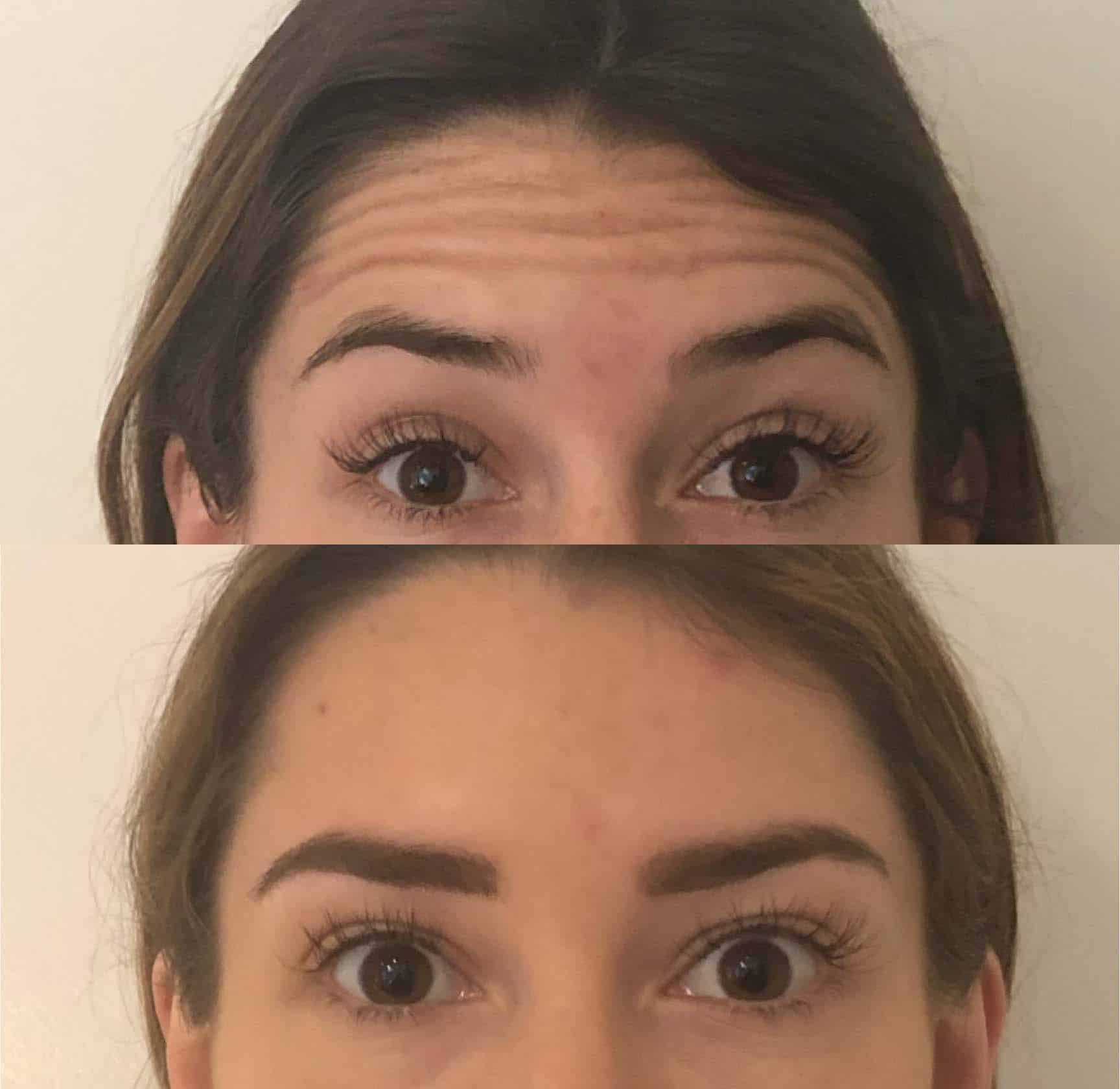 Before and after injectable treatment, case 1.