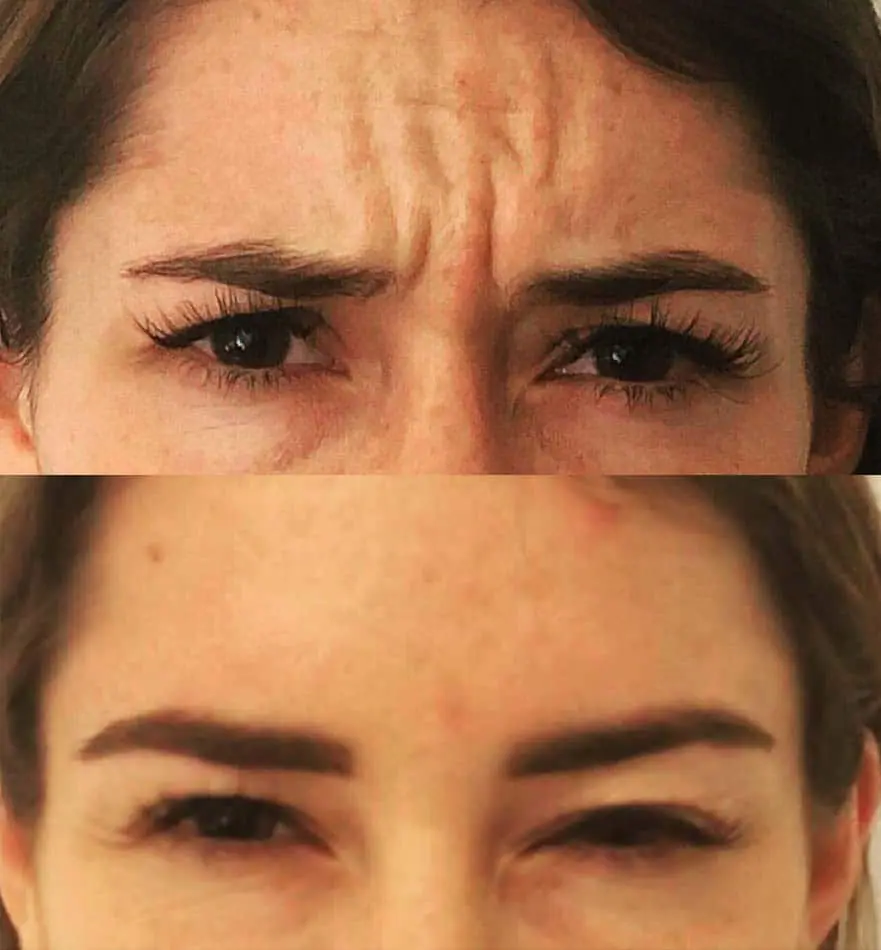 Before and after injectable treatment, case 2.