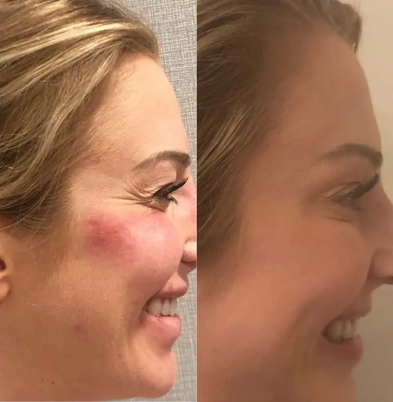Before and after injectable treatment, case 3.