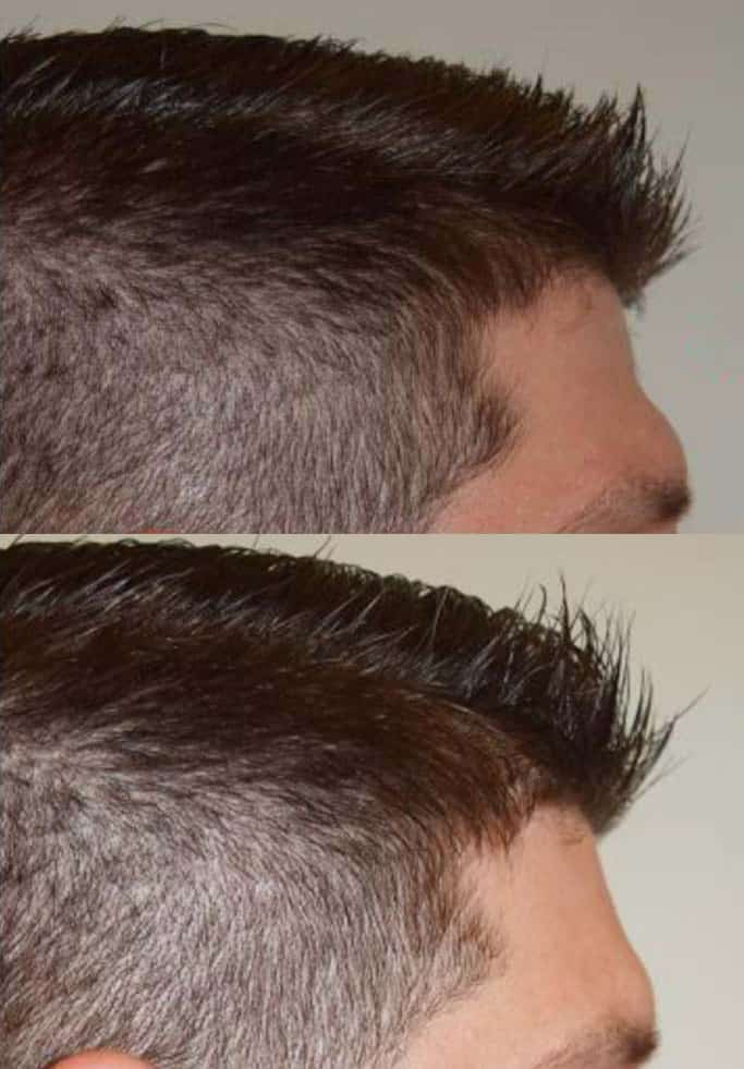 Before and after injectable treatment, case 4.