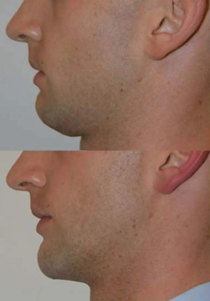 Before and after injectable treatment, case 5.
