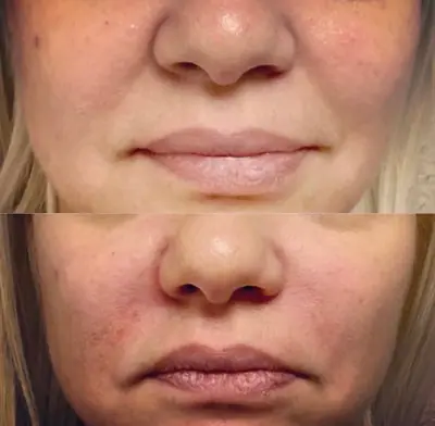 Before and after injectable treatment, case 6.