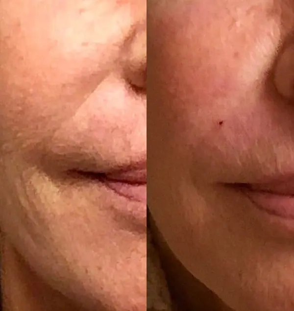 Before and after injectable treatment, case 7.