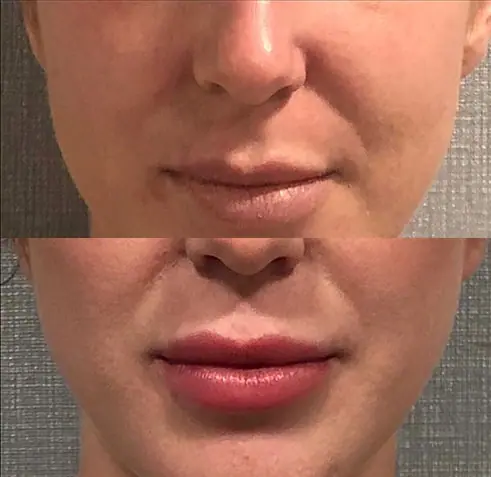 Before and after injectable treatment, case 8.