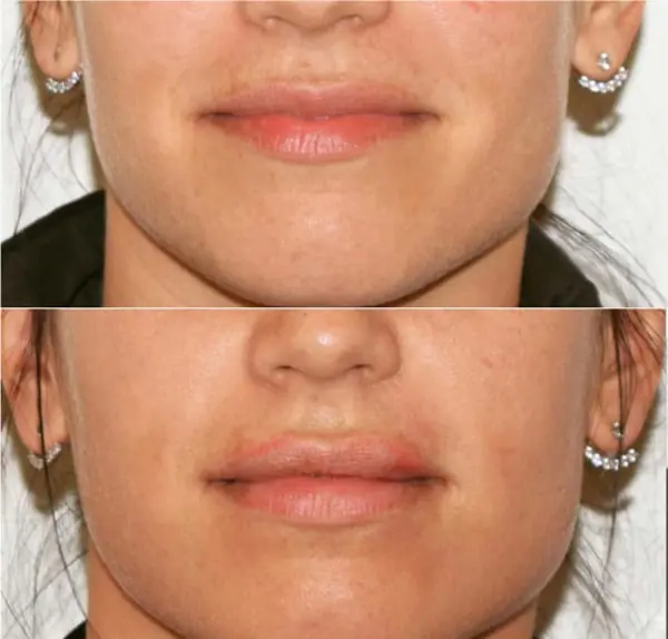 Before and after injectable treatment, case 9.