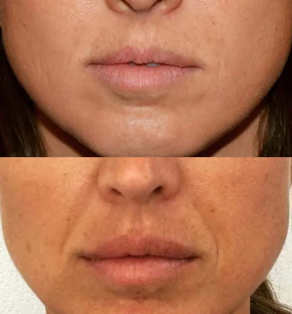 Before and after injectable treatment, case 10.