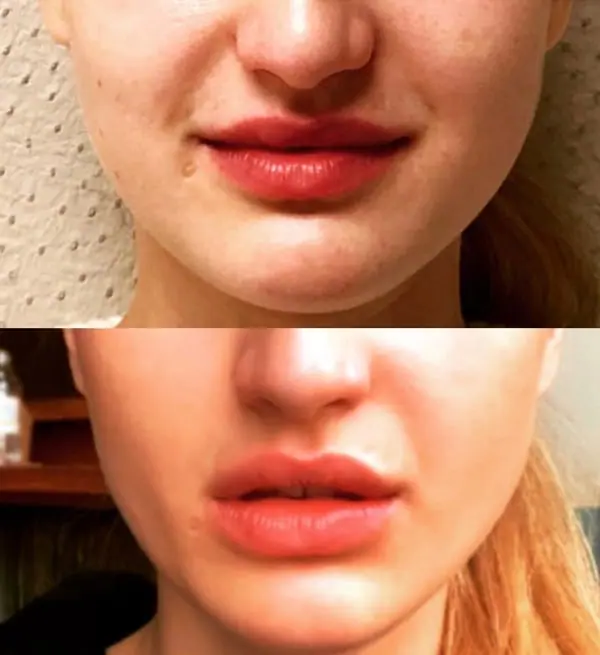 Before and after injectable treatment, case 11.