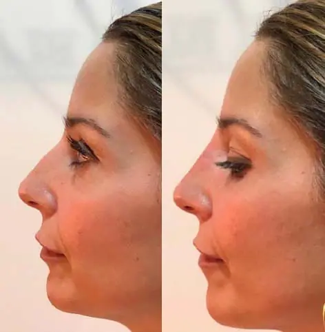 Before and after injectable treatment, case 12.
