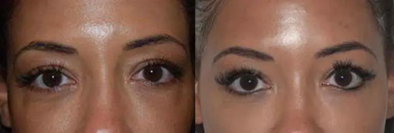 Before and after injectable treatment, case 13.