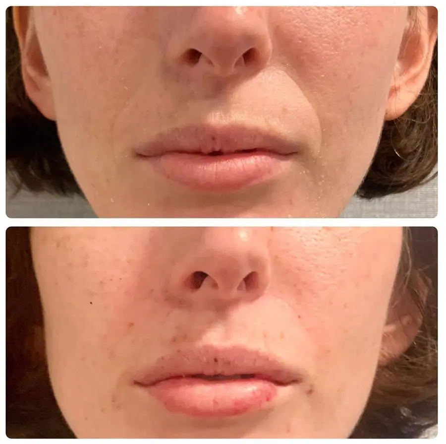 Before and after injectable treatment, case 14.