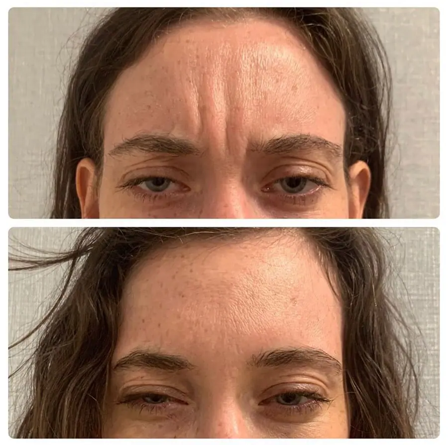 Before and after injectable treatment, case 15.