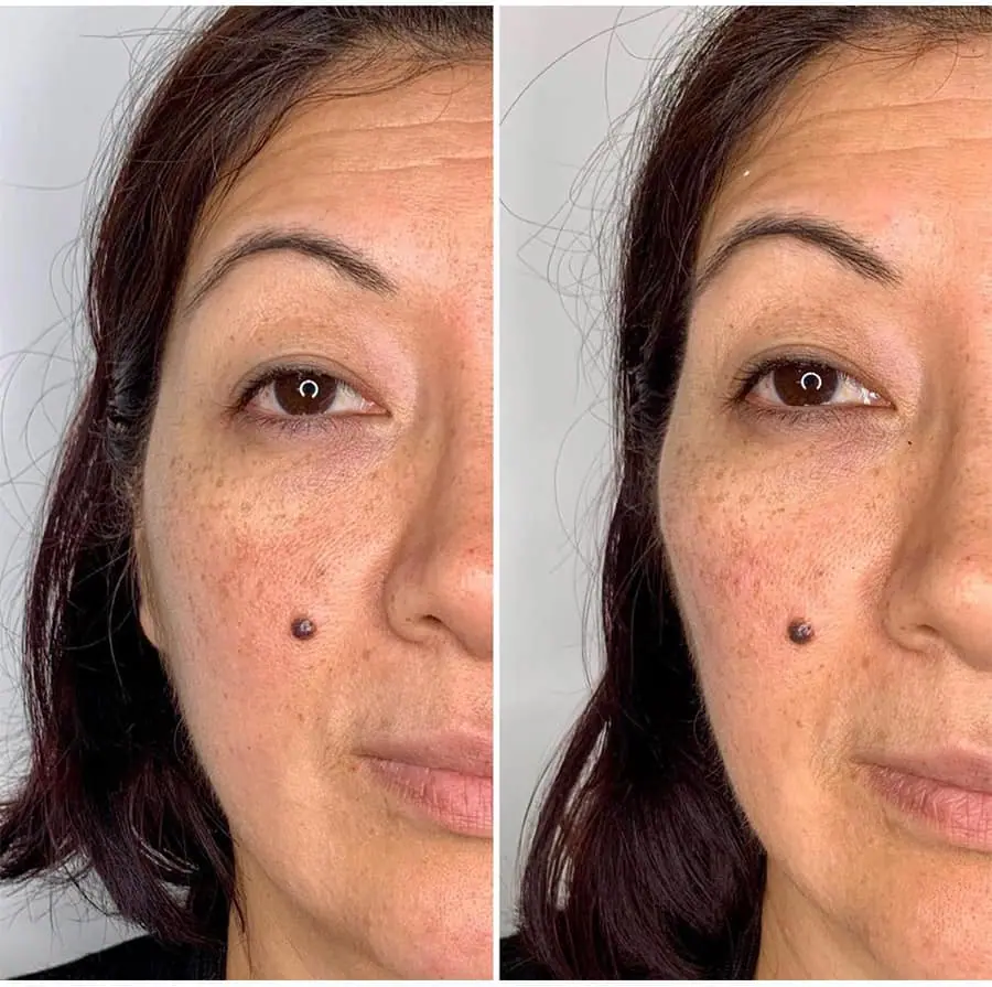 Before and after injectable treatment, case 16.