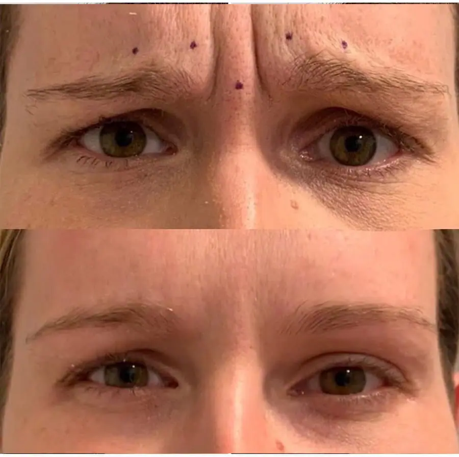 Before and after injectable treatment, case 17.