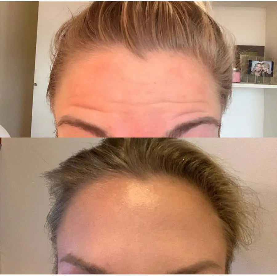 Before and after injectable treatment, case 18.
