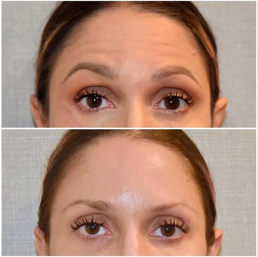 Before and after injectable treatment, case 19.