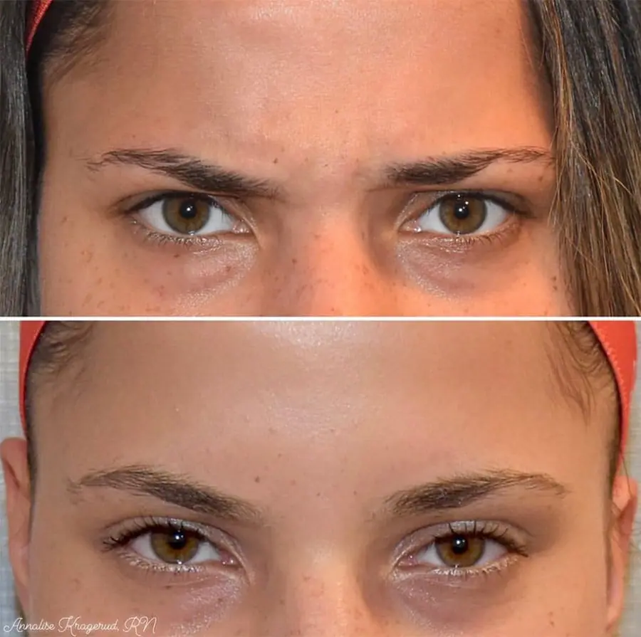 Before and after injectable treatment, case 20.