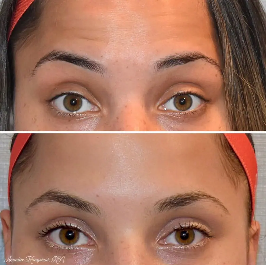 Before and after injectable treatment, case 21.