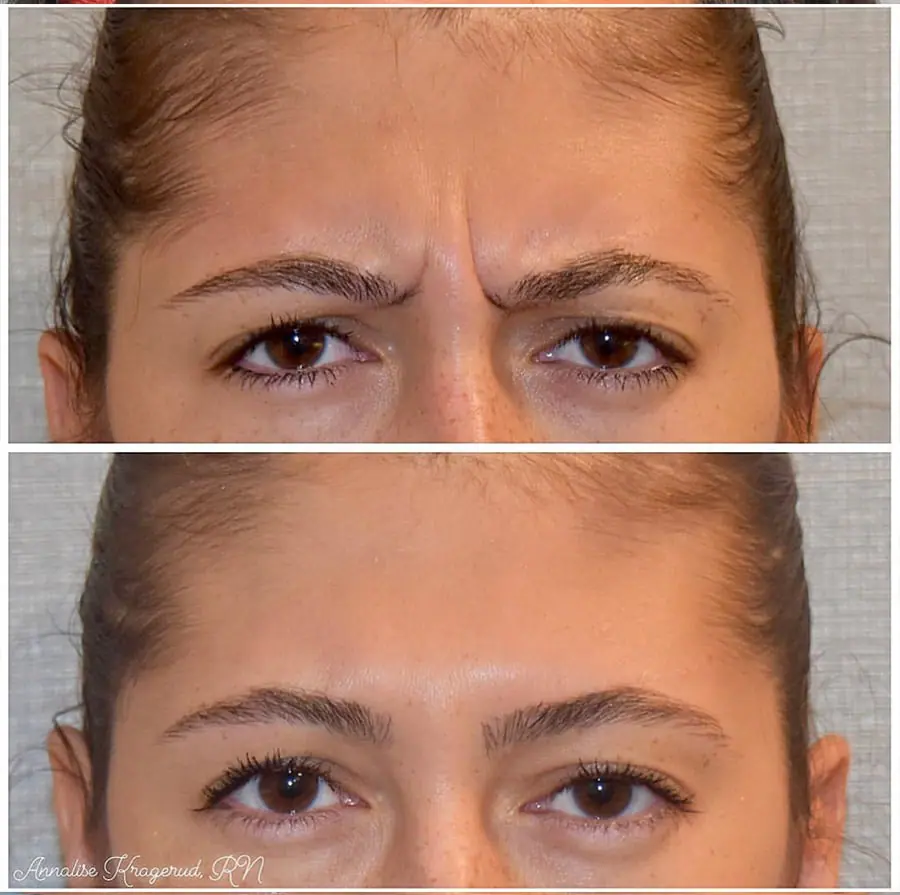 Before and after injectable treatment, case 22.