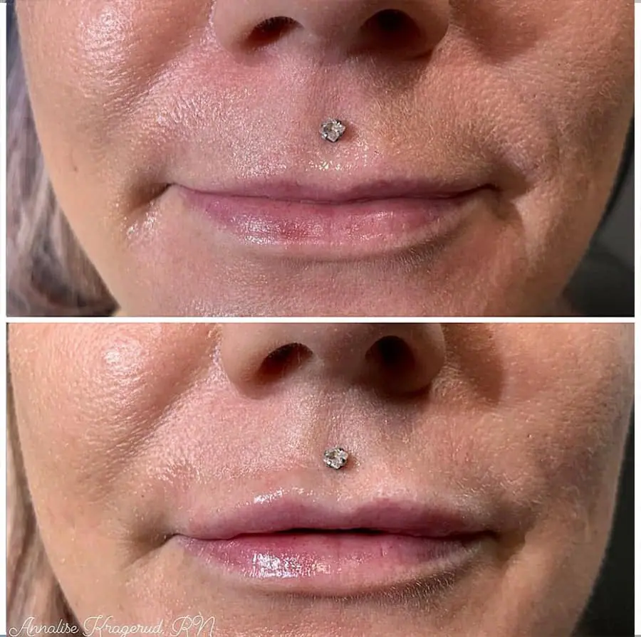 Before and after injectable treatment, case 23.