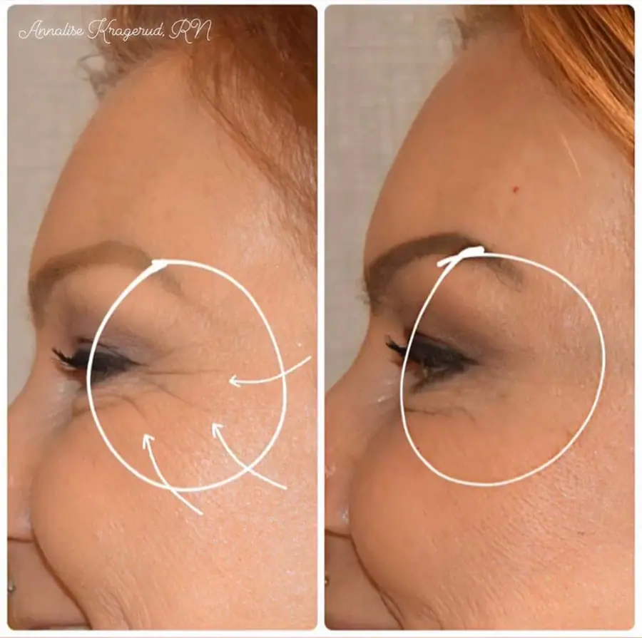 Before and after injectable treatment, case 24.