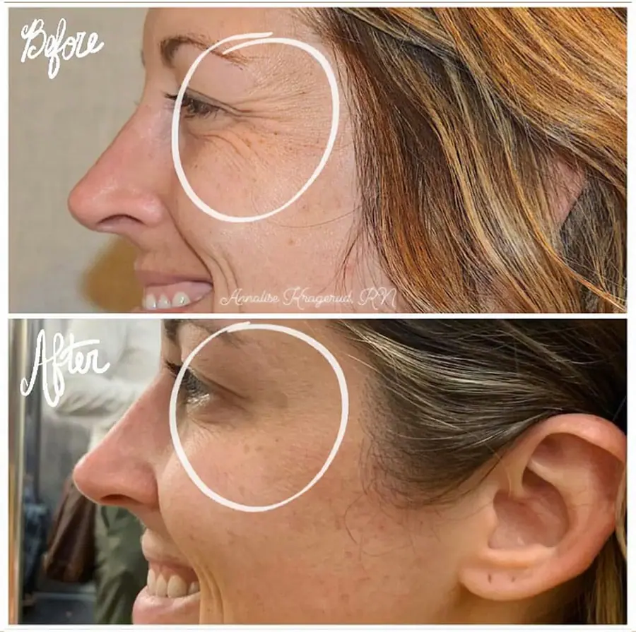 Before and after injectable treatment, case 25.