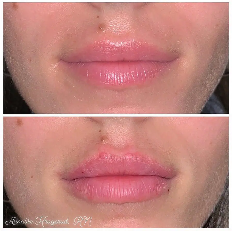 Before and after injectable treatment, case 26.