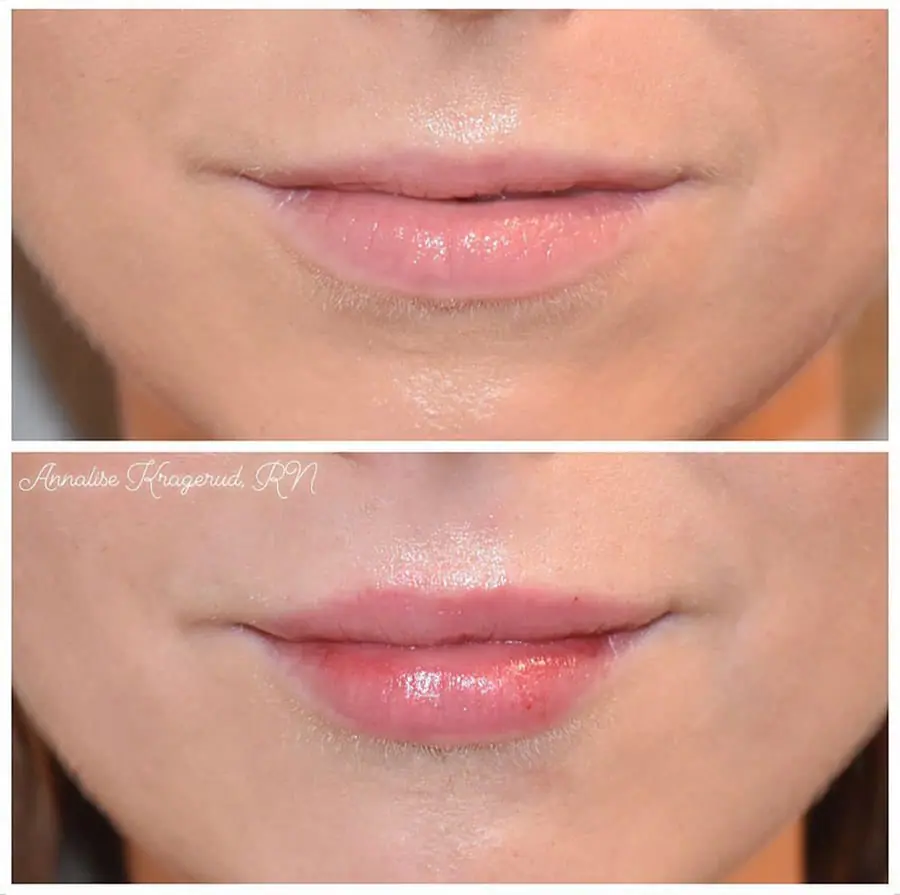 Before and after injectable treatment, case 27.