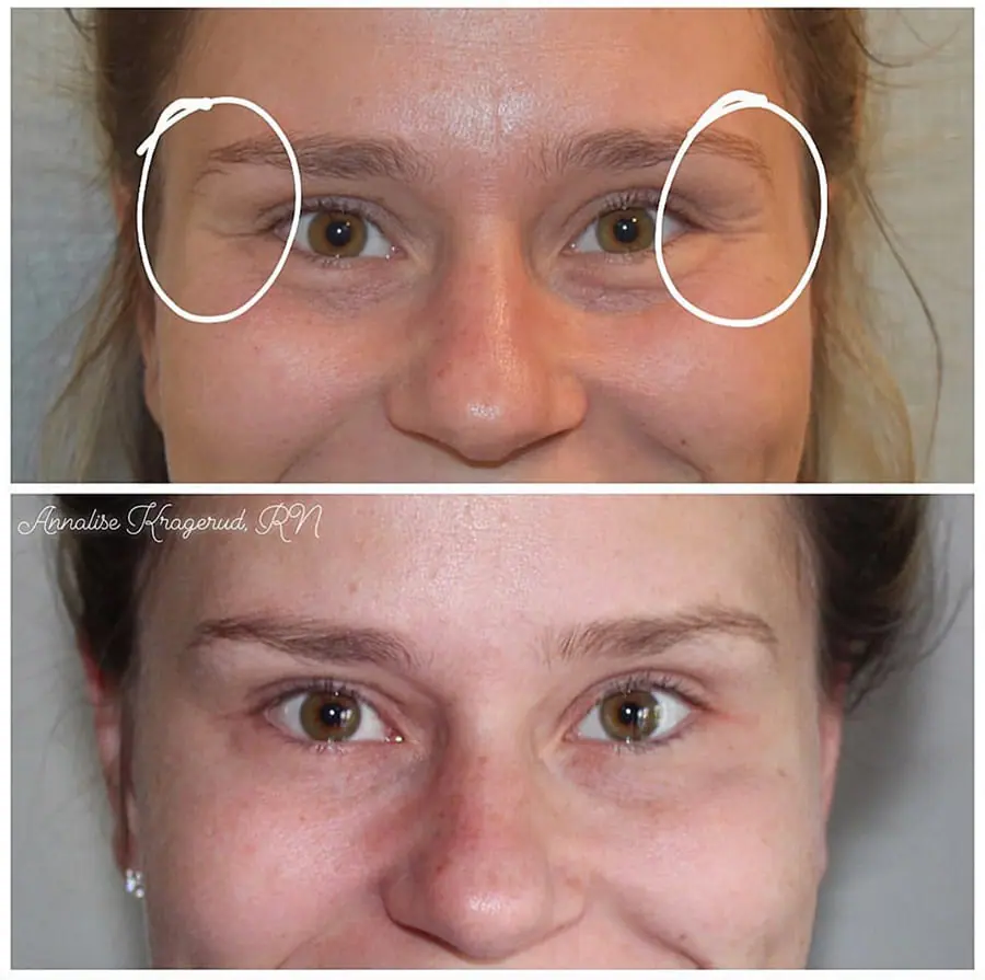 Before and after injectable treatment, case 28.