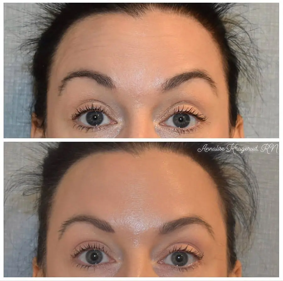 Before and after injectable treatment, case 29.