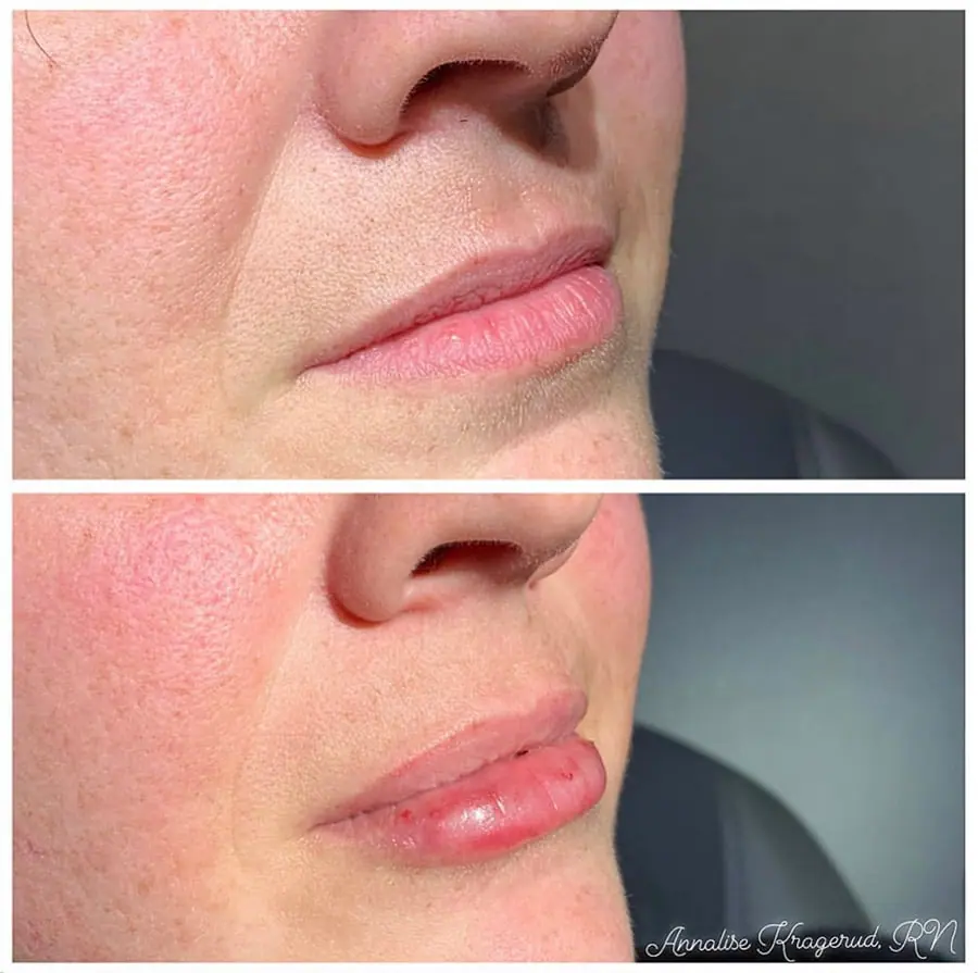 Before and after injectable treatment, case 30.