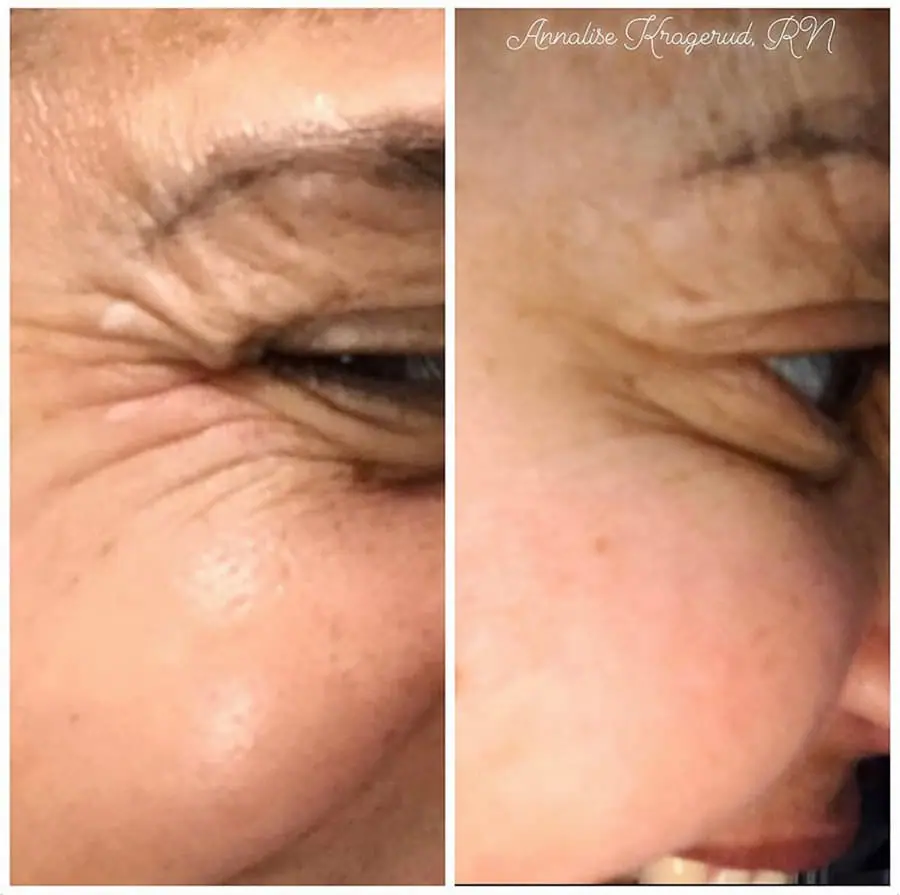Before and after injectable treatment, case 31.