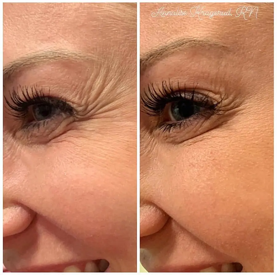 Before and after injectable treatment, case 32.