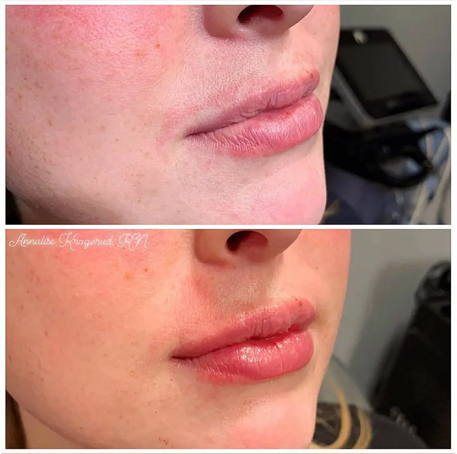 Before and after injectable treatment, case 33.