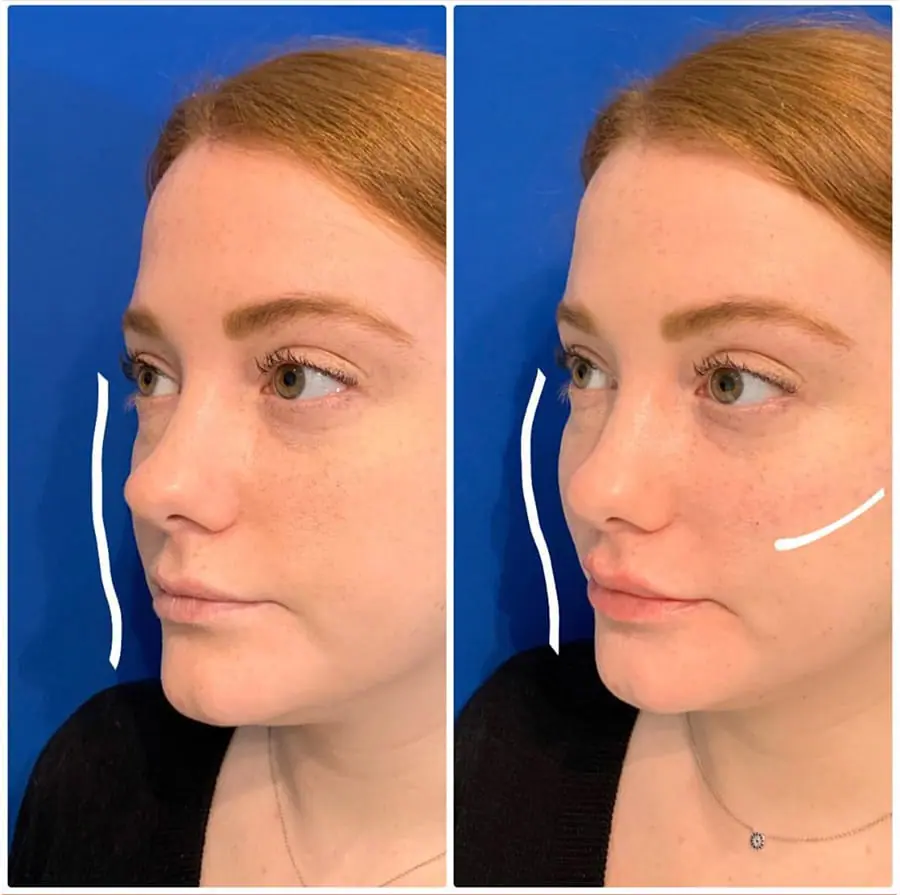 Before and after injectable treatment, case 34.