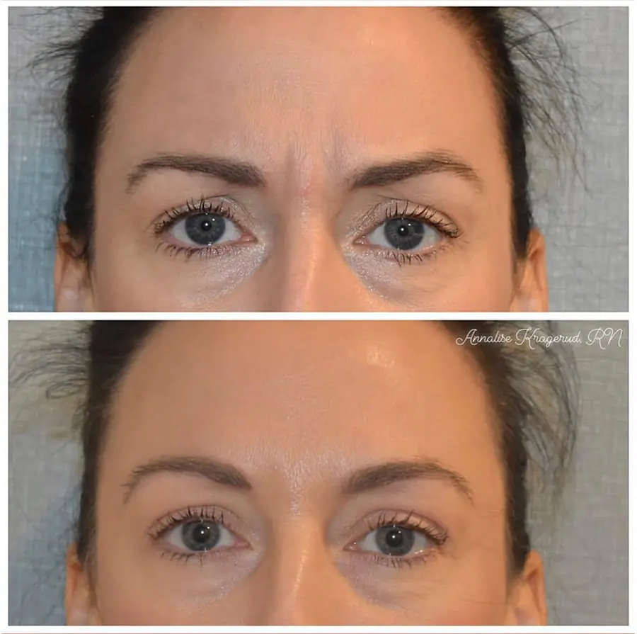 Before and after injectable treatment, case 35.