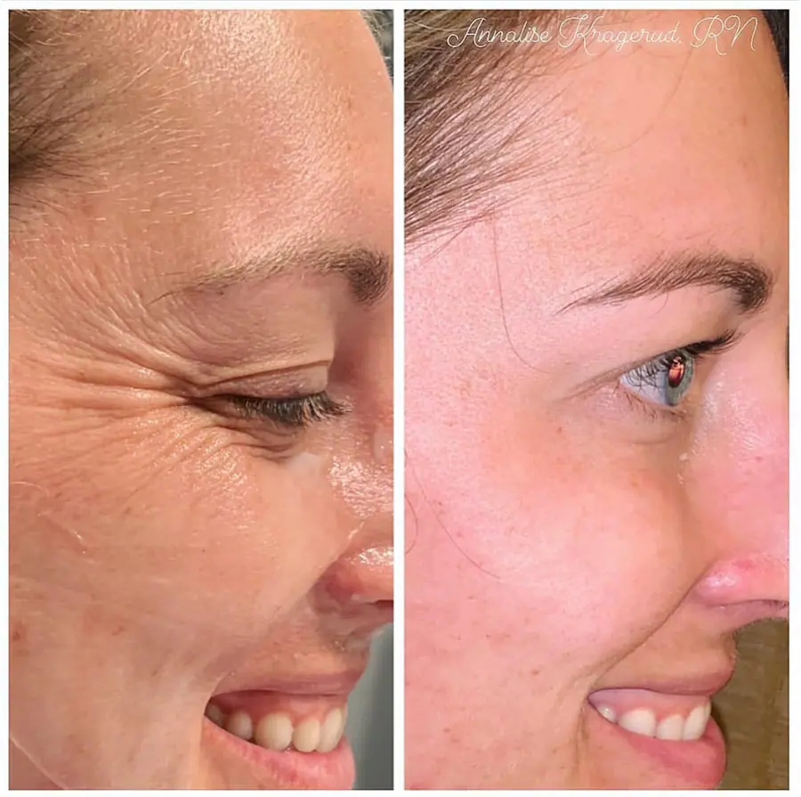 Before and after injectable treatment, case 36.