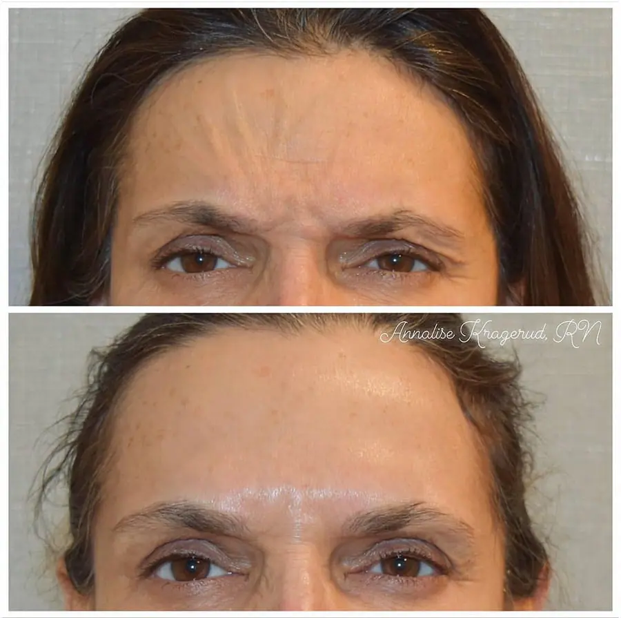 Before and after injectable treatment, case 37.