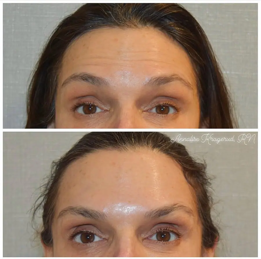 Before and after injectable treatment, case 38.