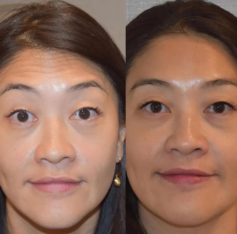 Before and after injectable treatment, case 39.