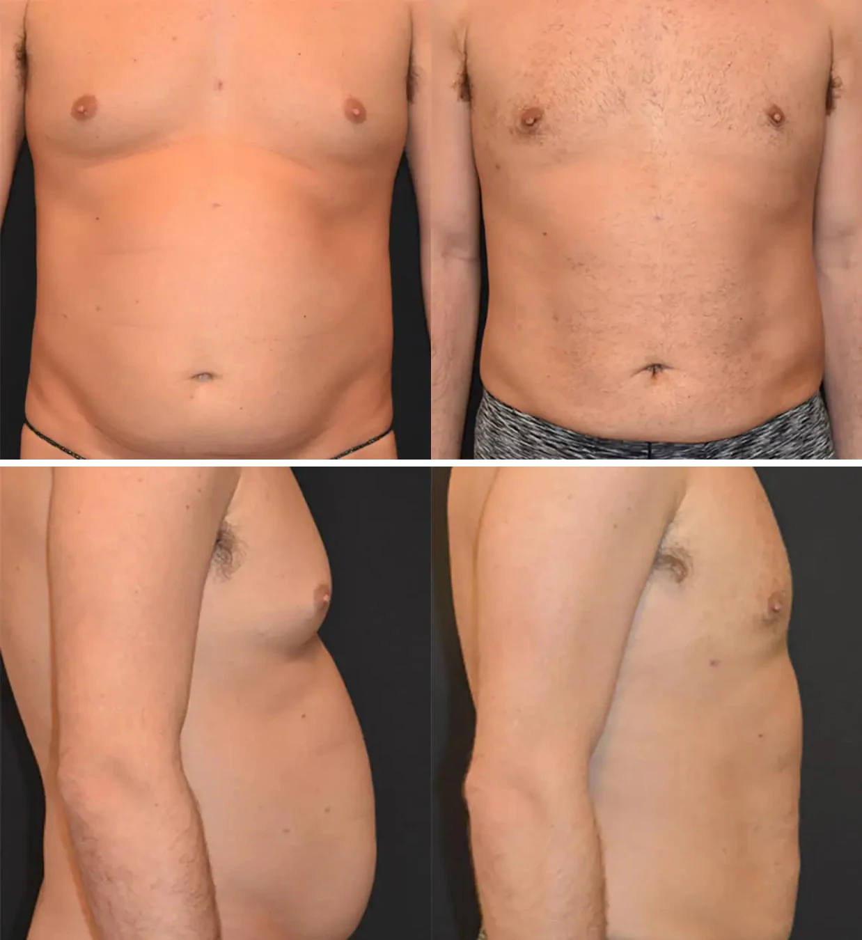 Before and after male liposuction, case 1.