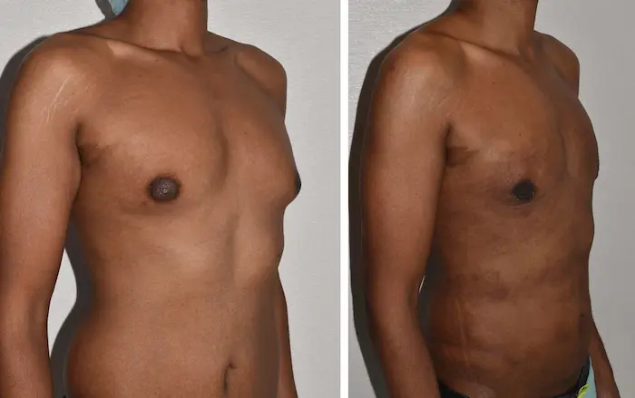 Before and after gynecomastia surgery, case 1.