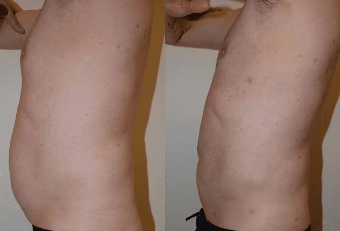 Before and after liposuction, case 5.
