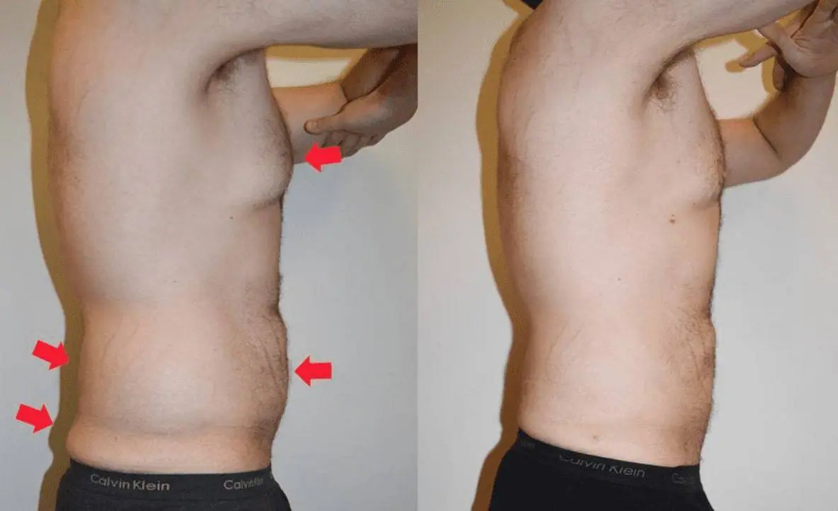Before and after liposuction, case 7.