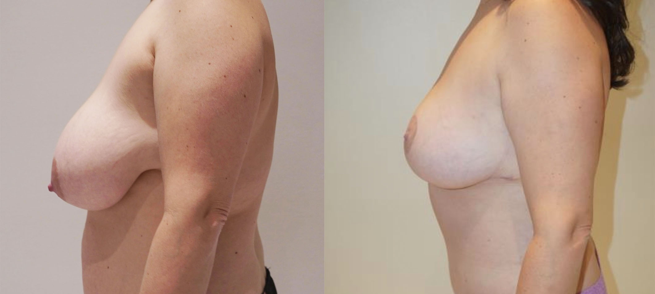 Before and after breast lift, case 4.